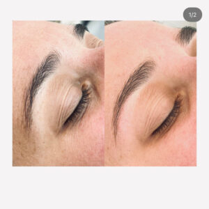 Suikerontharing wenkbrauwen